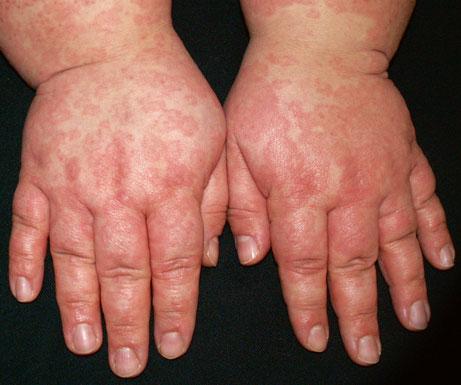 Characteristic Features of Adverse Cutaneous Drug Reactions 21 Erythema Multiforme-Like Drug Eruption Classical EM that is usually associated with herpes simplex and other infections is characterized