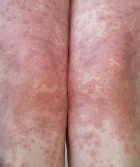 22 1 General Aspects of Adverse Cutaneous Drug Reactions Fig. 1.35 Dusky red- to violaceous-colored, confluent targetoid lesions on the lower extremities in erythema multiforme-like drug eruption The