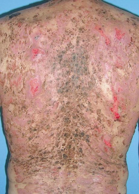 Characteristic Features of Adverse Cutaneous Drug Reactions 23 Fig. 1.