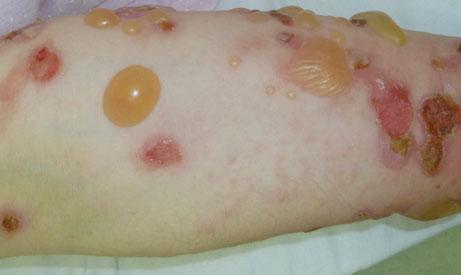 24 1 General Aspects of Adverse Cutaneous Drug Reactions Drugs that can cause pemphigus are divided into three groups, namely, thiol drugs (containing sulfhydryl radical) such as captopril,
