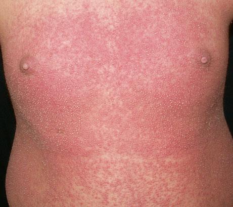 Characteristic Features of Adverse Cutaneous Drug Reactions 25 Pustular Drug Eruption/Acute Generalized Exanthematous Pustulosis Pustular eruption induced by drugs may be localized or generalized.