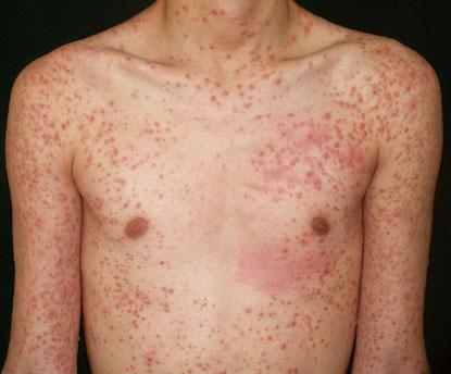 normal-appearing skin in a patient receiving systemic corticosteroids Fig. 1.