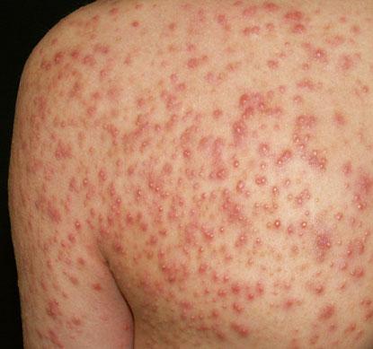 close-up of monomorphic papules and pustules on normal-appearing skin in a patient