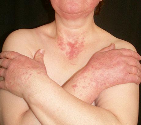 sun-exposed skin of a patient receiving hydrochlorothiazide Fig. 1.