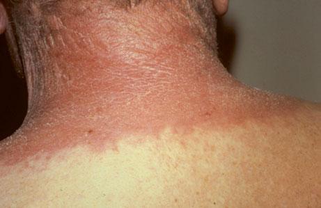48 Photosensitivity presenting with erythema, edema, scaling, and lichenification on