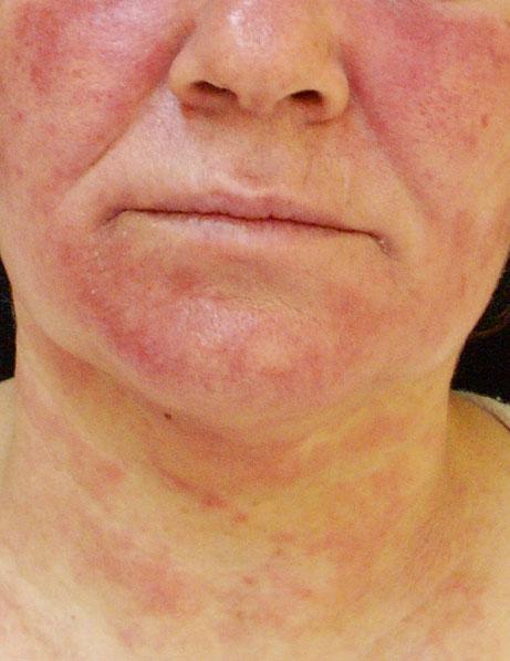 30 1 General Aspects of Adverse Cutaneous Drug Reactions Fig. 1.49 Photosensitivity presenting with erythema, edema, and scaling in a photodistributed pattern on the face and neck in a patient