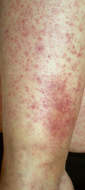 32 1 General Aspects of Adverse Cutaneous Drug Reactions Fig. 1.51 Dusky red- to purple-colored, petechial purpuric lesions on the arm which are nonblanchable on diascopy Drug-Induced Vasculitis