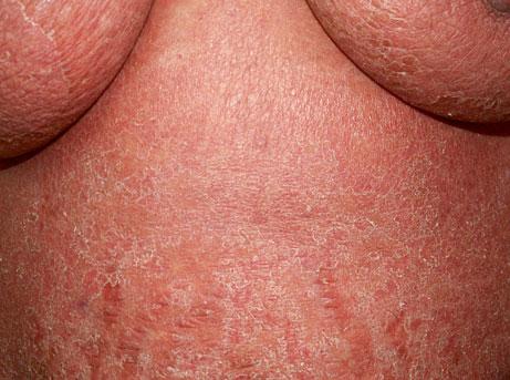 36 1 General Aspects of Adverse Cutaneous Drug Reactions Fig. 1.57 Erythroderma/ exfoliative dermatitis showing diffuse erythema and desquamation of the skin of drug-induced erythroderma [ 4, 48 ].