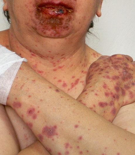 Characteristic Features of Adverse Cutaneous Drug Reactions 37 Fig. 1.