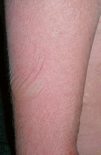 Characteristic Features of Adverse Cutaneous Drug Reactions 39 Fig. 1.
