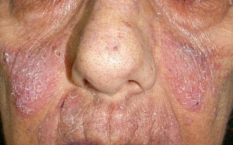 Characteristic Features of Adverse Cutaneous Drug Reactions 41 deficiency or a factor V Leiden mutation [ 62 ].