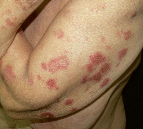42 1 General Aspects of Adverse Cutaneous Drug Reactions Fig. 1.63 Erythematosquamous plaques on the back and symmetrically on the upper extremities, mainly in annular polycyclic configuration, in a