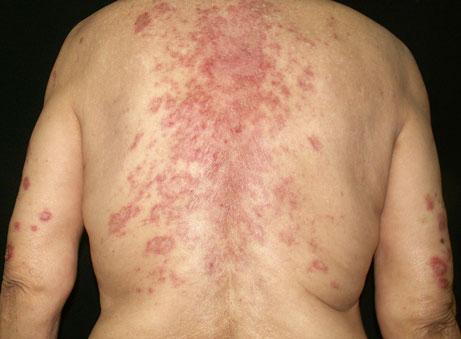 64 Erythematosquamous plaques on the arms, mainly in annular polycyclic configuration, in a patient with subacute cutaneous lupus erythematosus-like eruption possibly induced by filgrastim, a