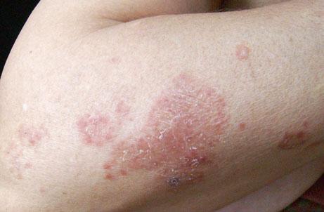 thiazides and ACEIs (captopril) may induce a pityriasis rosealike eruption [76 ].