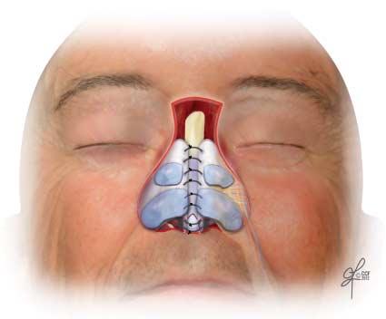 Figure 1. The reconstructive skeletal framework for a total or near-total defect. Harvested septal, costal, and/or auricular cartilage are used to recreate the nasal ala and sidewalls.