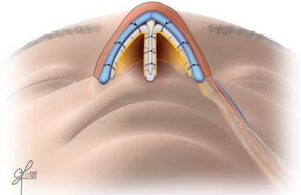This L-strut provides a nasal framework along with dorsal and caudal support. Vascularized fascia lata is interwoven and suspended around the rib graft to establish an underlying nasal lining.