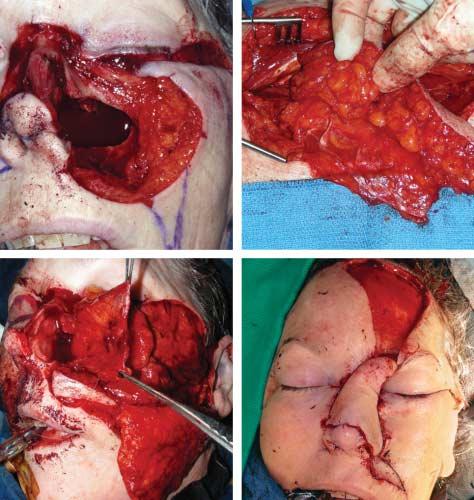 A A Figure 4. Operative photographs of a 59-year-old woman with a large, neglected basal cell carcinoma of the left nasofacial sulcus and nose (case 1).