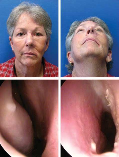 She also underwent anterior and medial maxillectomy (A). Reconstruction of the nasal lining was performed using free vascularized fascia lata ( and ).