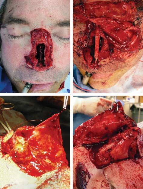 A A Figure 6. Operative photographs of a 54-year-old man with desmoplastic melanoma of the nasal skin and anterior nasal septum (case 2). He underwent a subtotal rhinectomy and partial septectomy (A).