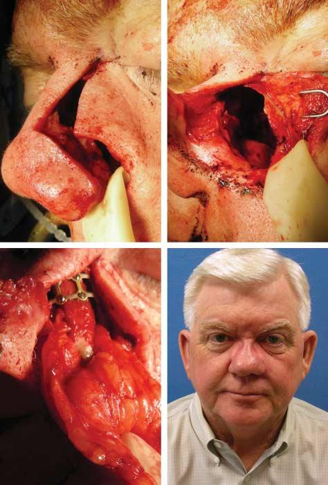 A maxillectomy and total septectomy were performed, along with mucosal resection extending to the ethmoid air cells and anterior skull base.