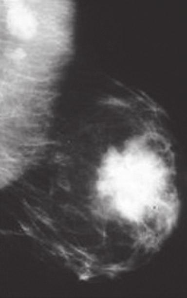 20 N. Arora and R.M. Simmons Figure 2.1. Mammogram of a large spiculated breast mass (Courtesy of Dr. Ruth Rosenblatt, Professor of Radiology, Weill Medical College of Cornell University).