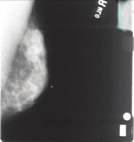 2 Malignant Breast Disease: Diagnosis and Assessment 21 Figure 2.2. Mammogram of plesiomorphic calcifications (Courtesy of Dr. Ruth Rosenblatt).