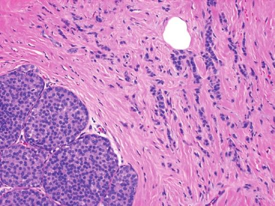24 N. Arora and R.M. Simmons Figure 2.4. Lobular carcinoma in situ (LCIS) and invasive lobular carcinoma: Lobular carcinoma in situ is characterized by neoplastic proliferation of monotonous cells that distend and distort the lobules.