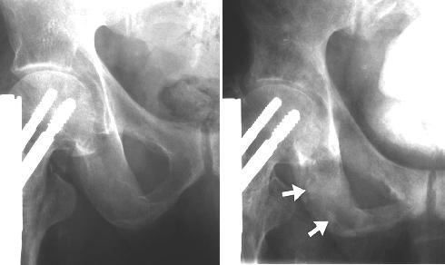 Prostate Cancer X-rays show new blastic lesions from prostate cancer Bone metastases frequently involve spine Characteristic x-ray findings suggest enhanced osteoblastic activity Bone lesions more