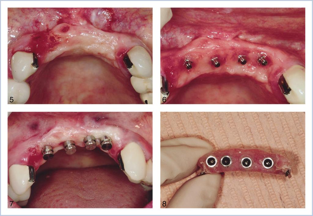 Dennis Flanagan FIGURES 5 8. FIGURE 5. Preoperative maxillary anterior site. FIGURE 6. Implants in place. FIGURE 7. Attachment housings in place for pick-up partial denture. FIGURE 8.