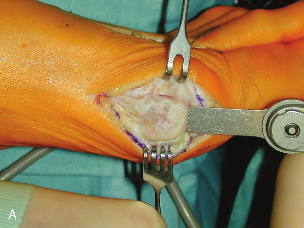 Trnka and Hofstaetter FIGURE 3. Medial skin incision for the osteotomy.