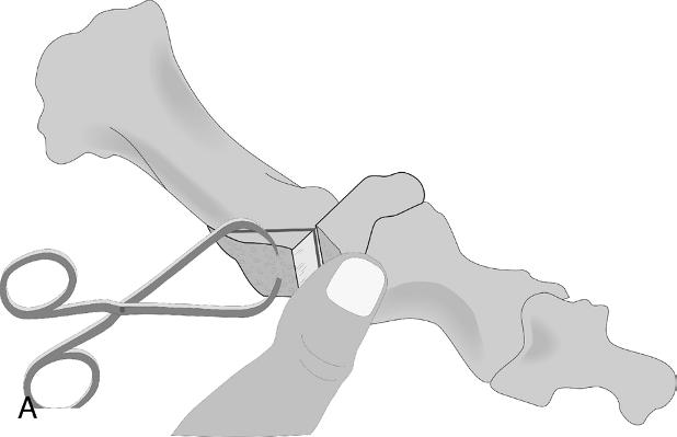 Chevron Osteotomy the other hand (Figs. 7A, B).
