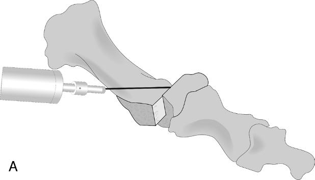 A guide wire for a cannulated BOLD screw (New Deal SA, Vienne, France) is then inserted from the distal dorsal metatarsal shaft obliquely to lateral plantar of the metatarsal head