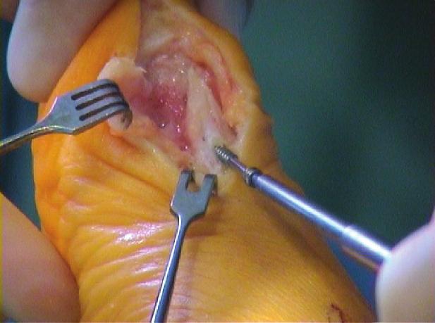 Attention is now directed toward the medial capsule, and a wedge of approximately 5 mm is removed from the short arm of the L-type capsular incision.