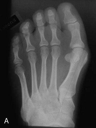 This stocking entails the benefit of reducing edema and keeping the hallux in a straight position. follow-up.
