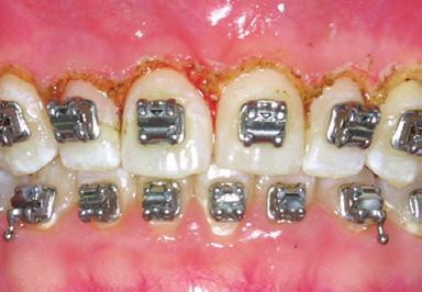 A frenectomy prevents the need for future grafting by