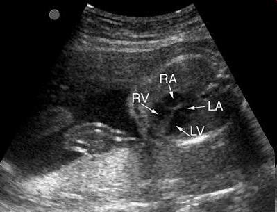 Fetal Echocardiogram M-mode and doppler Structural defects and