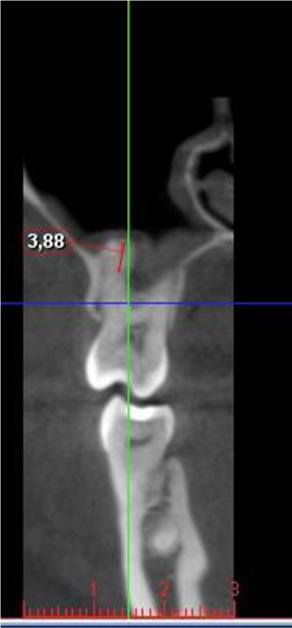 working independently of each other. Whenever there was disagreement on the parameters under study, then a dental radiologist was consulted. Statistical validity is considered to be p<0.05. Figure 1.