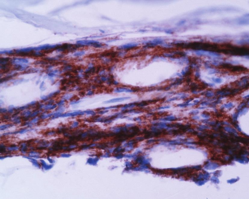 International Rheumatology 3 Figure 2: (Case 5). Immunoperoxidase staining with CD20, demonstrating the great majority of cells to be B lymphocytes, suggesting a humoral pathophysiologic diathesis.
