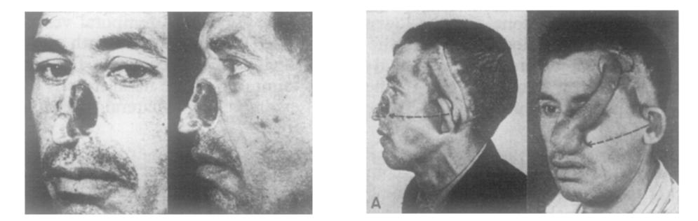 Partial loss of left side of the nose. Fig.