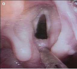 Laryngeal Cleft Rare Congenital Lesion First described in 1972 Due to incomplete fusion of Tracheobronchial Groove Slightly favors males than females Prematurity and Polyhydramnios increase risk