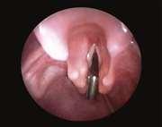 Laryngeal Cleft What grade cleft is this the metal piece marks the