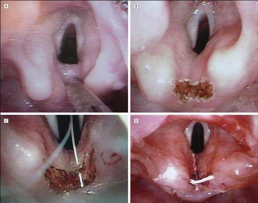 Laryngeal Cleft Grade I and II Start with anti-reflux meds and thickened feeds If resistant, endoscopic approach with laser Grade II and higher Anterior open