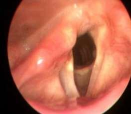 Unilateral Vocal Cord Paralysis Rule out concomitant lesions Is feeding an issue?
