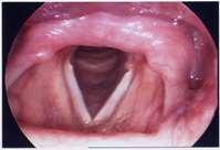 Vocal Cord Granuloma Mild Observation