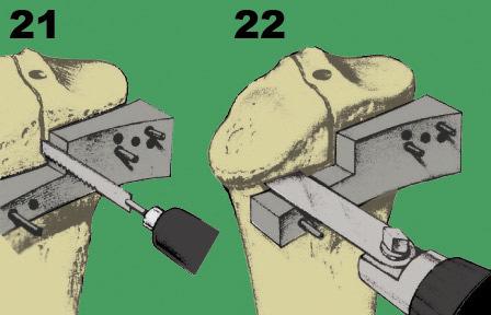 PROXIMAL TIBIA RESECTION: Using a reciprocating saw, complete the vertical resection of the tibia (Fig, 21). Leave the cutting block in place.