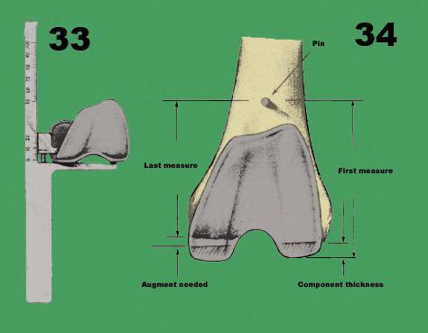 Remove the femoral component. Use the Distal Resection Gauge to measure the thickness of the distal portion of the component (Fig. 33).