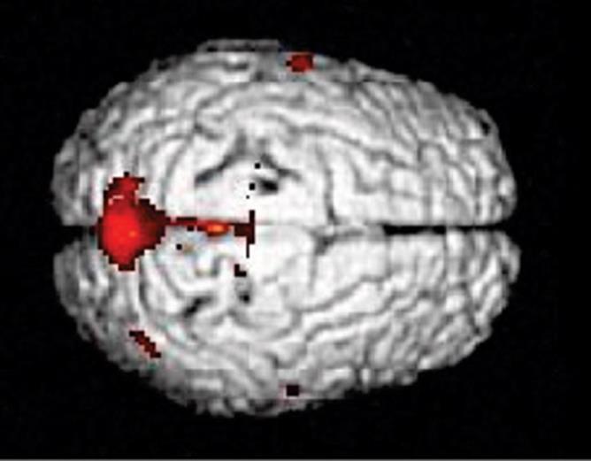 Effects of Lead on the Brain Functional MRIs showing areas of brain function after tasks requiring impulse control were