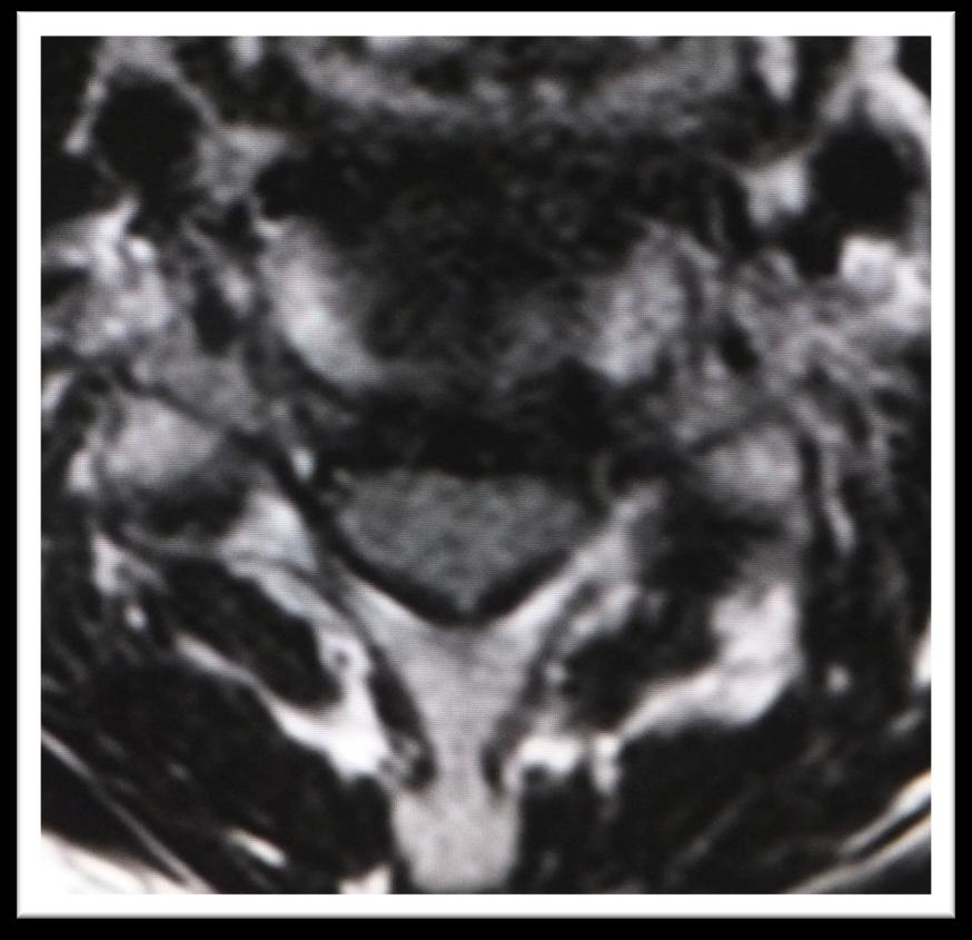 Angled Sagittal MRI A B A Angled Sagittal MRI