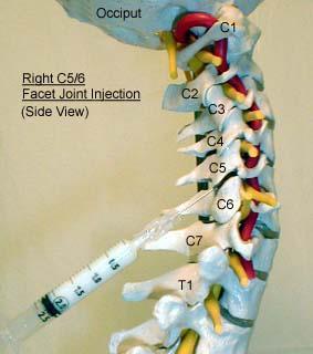 Cervical Facet Joint Injections Example: Unilateral, single-level injection into the C5-C6 facet joint level.