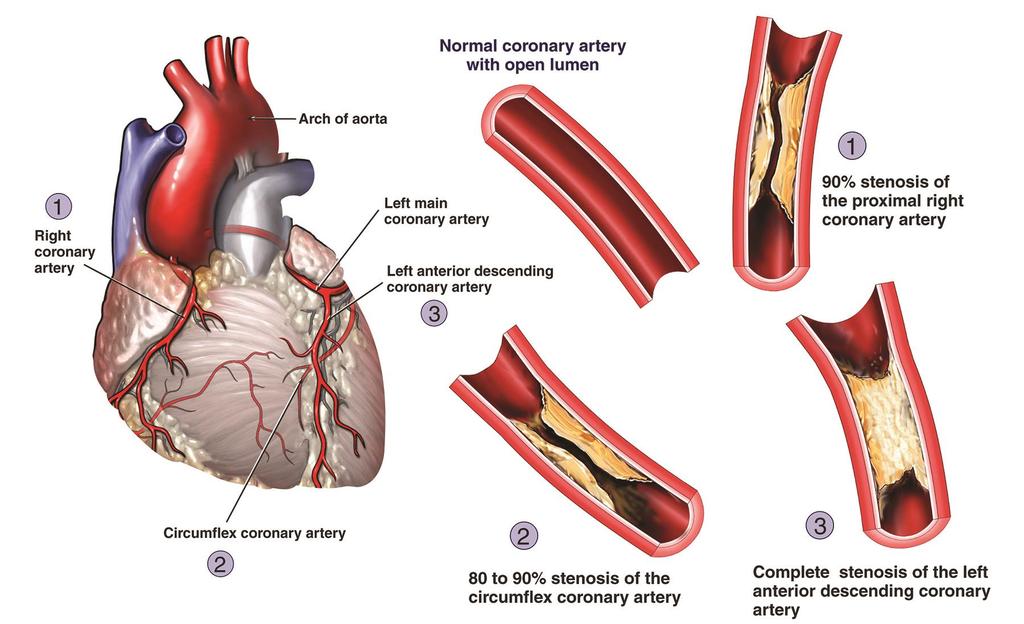 Arterial